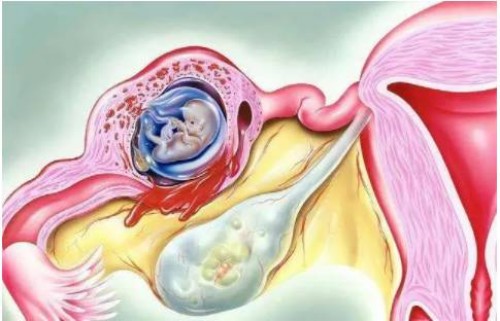 天津代生男孩：﻿孕囊不规则的原因解析，跟宫腔粘连有关
